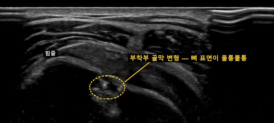 같은 어깨를 다른 방향에서 본 초음파 — 힘줄이 붙는 부착부의 골막 변형