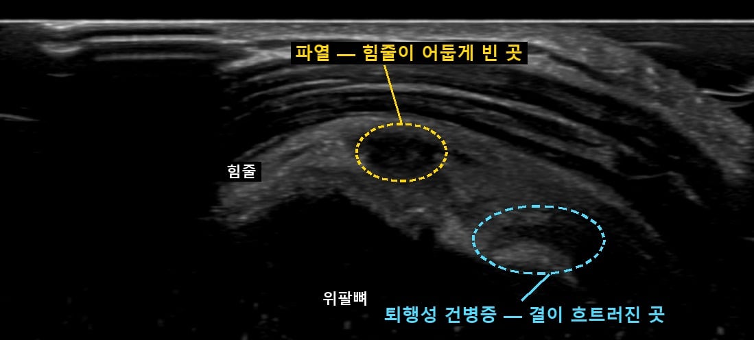 70대 여성 어깨 초음파 — 힘줄 가운데 어둡게 빈 파열 부위와 뼈에 붙는 쪽의 결이 흐트러진 퇴행성 건병증